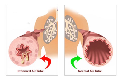 Obstructed Airways in Asthma